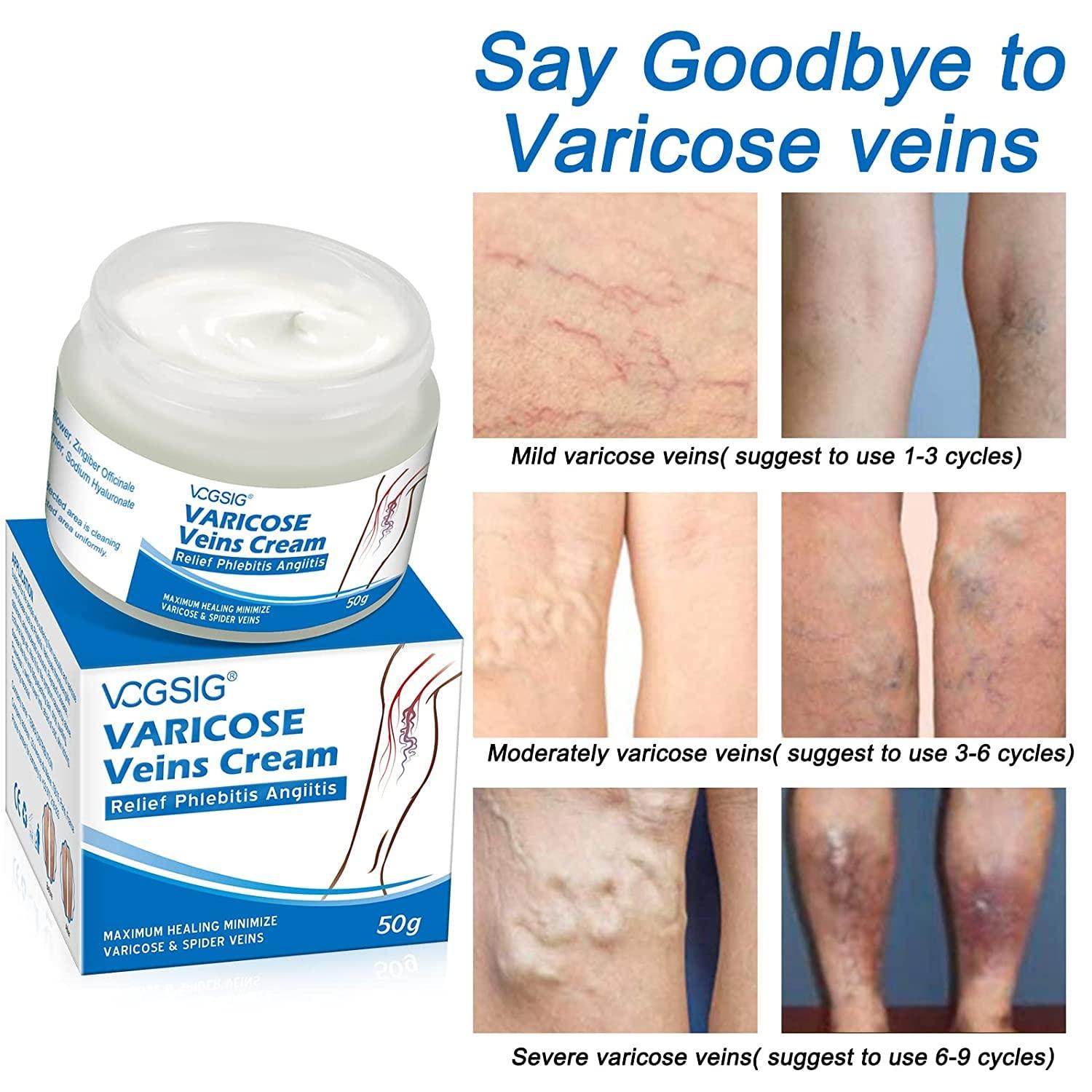 BOXANIA Boxania® Varicose Veins Cream, Soothing Leg with Natural Ingredients, Improves Blood Circulation of Spider Veins, Improve Pain of Legs - 50g