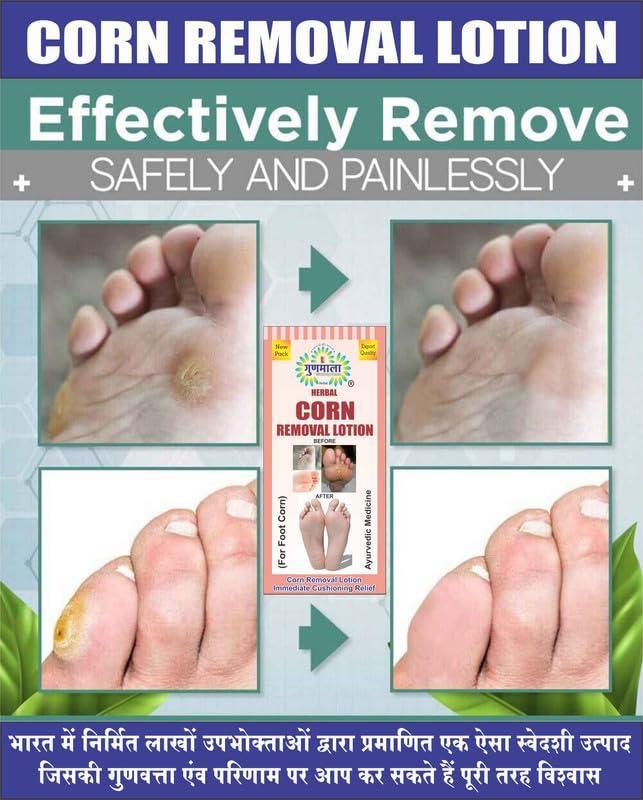 Gunmala Herbals Corn Mukti (Kill) Lotion | Kaal Aani Cream Foot Remover Callus & Kapasi Removal Paste For Removes Corns Relives From Pain Pinch In Walking - 30 ml.