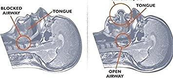 Frackson Frackson Tongue Anti Snoring Device Medical Silicone Anti Snore Device Apnea Aid Snore Stopper Tongue Retainer Anti Snoring Mouthpiece for Men & Women