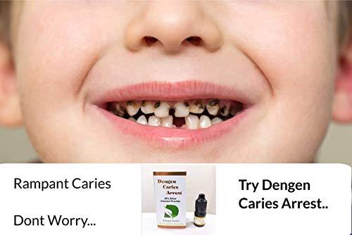Dengen Dental Dengen Caries Arrest Silver Diamine Fluoride