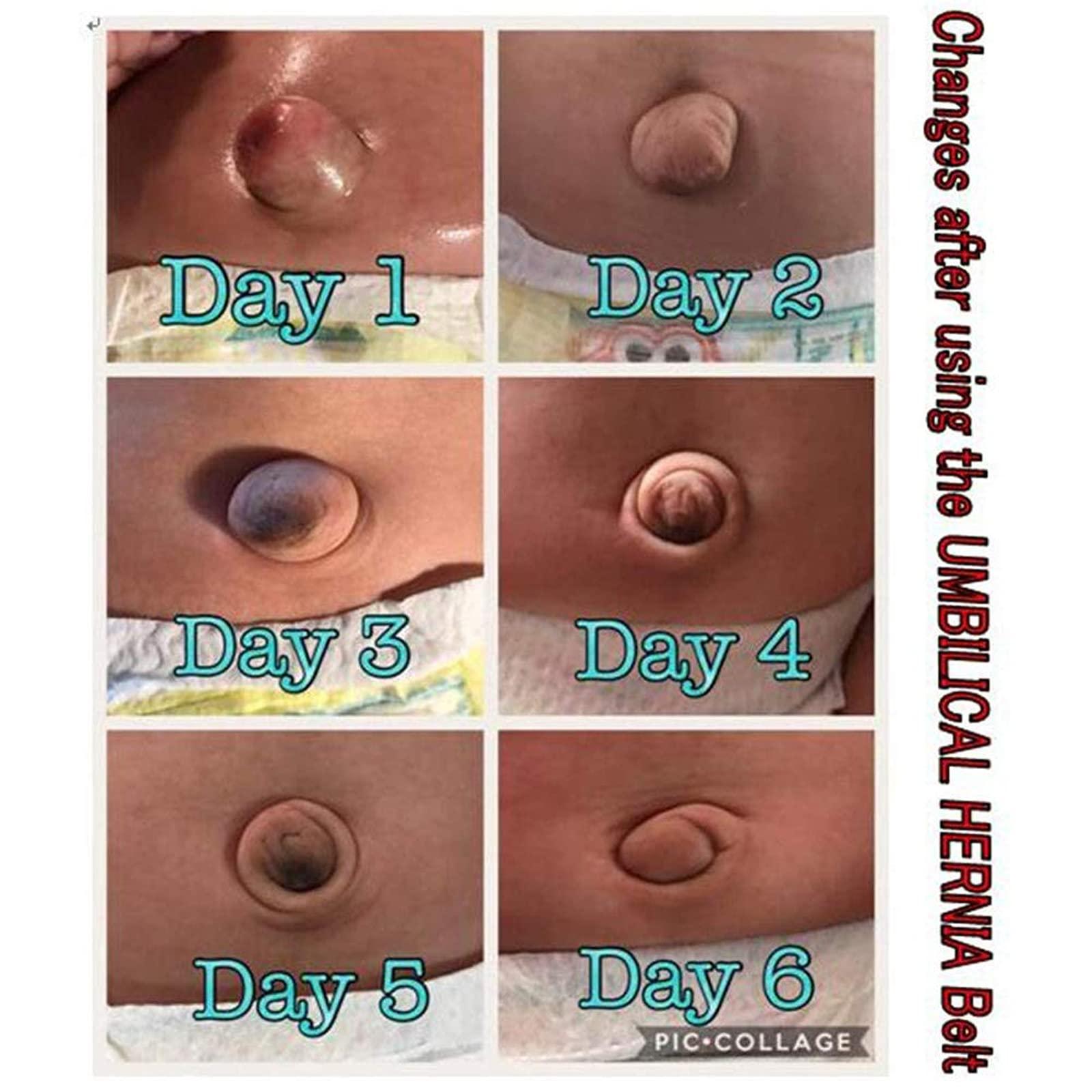 Paskyee Paskyee Umbilical Hernia Belt Baby Belly Button Band Infant Belly Wrap Abdominal Binder Hernia Truss Support Adjustable Navel Belly Band Newborn Umbilical Cord Blue