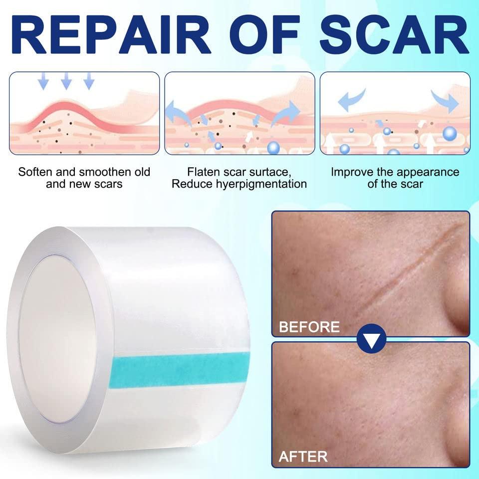 BOXANIA Boxania® Clear Silicone Scar Sheets, Silicon gel sheets for Scars Transparent Medical Silicone Gel Tape for Scar Removal, Silicone Scar Tape Roll For Hypertrophic Scars and Keloids Caused by Surgery