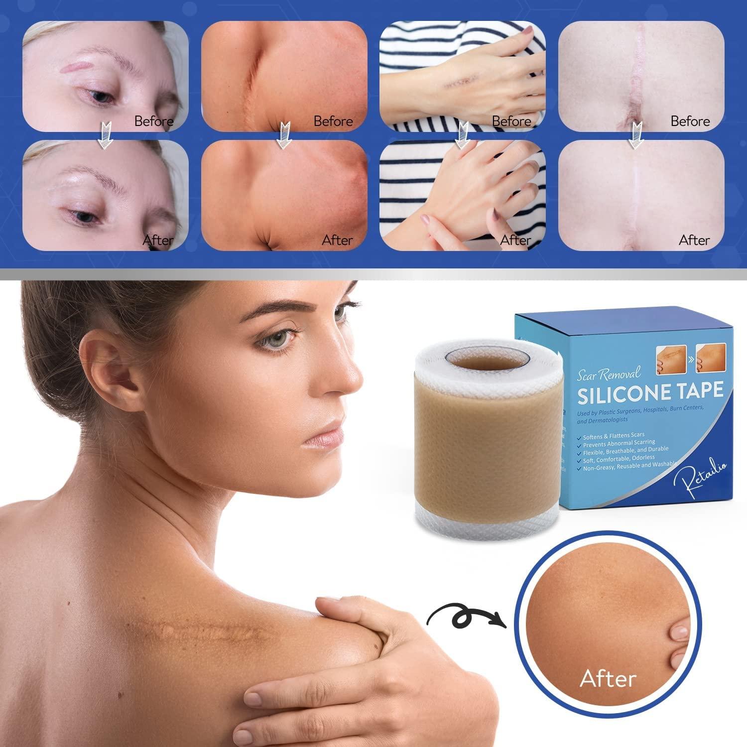 Retailio Retailio Silicone Scar Sheets Silicone Scar Tape 1.6x60" for Softening and Flattening Scars, C-Section, Keloid Surgery, Painless Removal, Reusable, Washable
