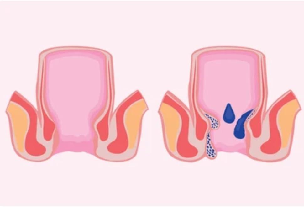 Generic Bavasir ki Dawa Ayurvedic Supplement for Piles- Promotes Digestive Health and Helps Relieve Pain - 10 Tablet (10 Day Course)