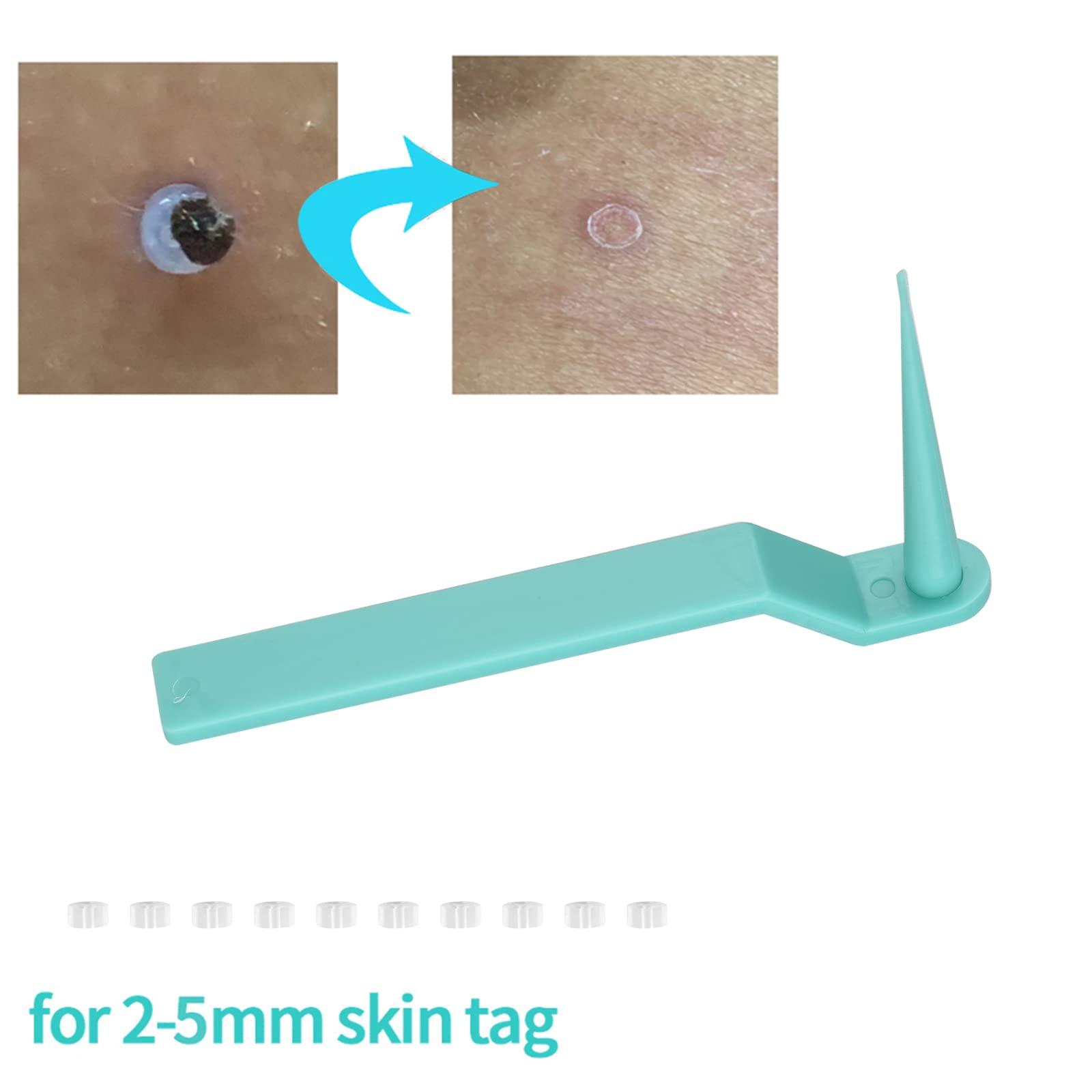 RYAP Skin Tag r Skin Tag Removal Kit for Removing Small to Medium (2mm to 4mm) Sized Skin Tags Painlessly
