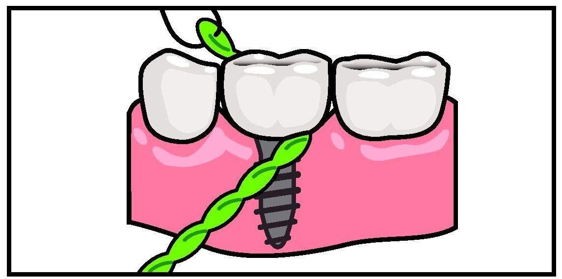 iDontix Idontix X-Floss 30 Strands Easy Bridge And Implant Floss by Idontix