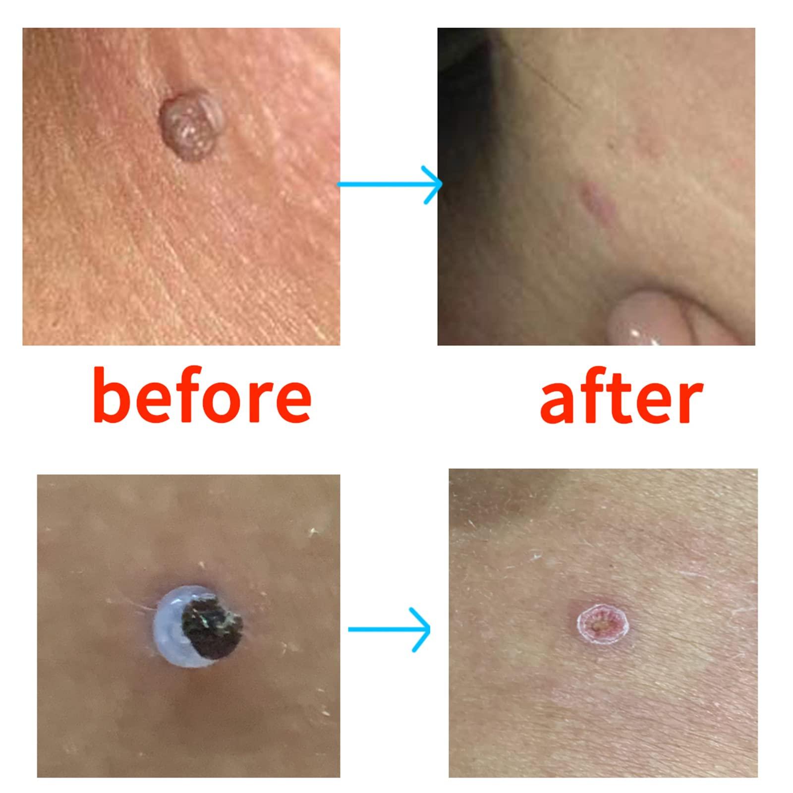 RYAP Skin Tag r Skin Tag Removal Kit for Removing Small to Medium (2mm to 4mm) Sized Skin Tags Painlessly