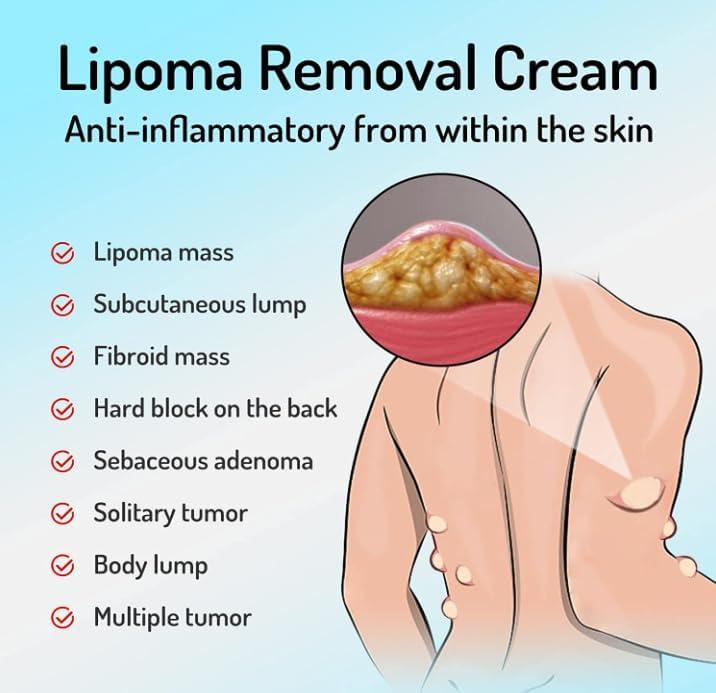 Lecherous Lipoma Removal Cream Mild Easy to Use Care Cream Wide Applaications | Mild & Comfortable | Herbal Remedies & Resins (Pack Of 3)