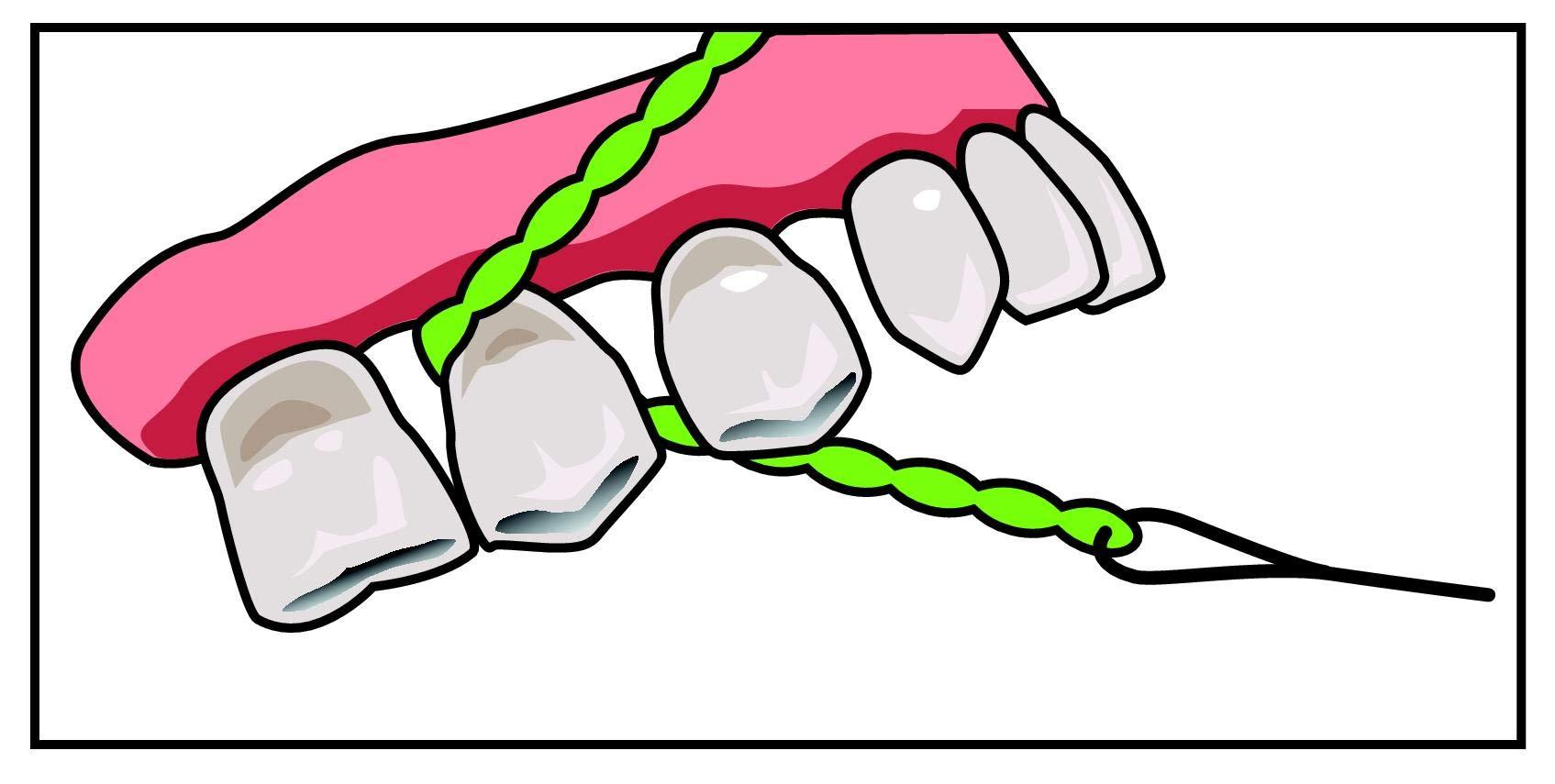 iDontix Idontix X-Floss 30 Strands Easy Bridge And Implant Floss by Idontix
