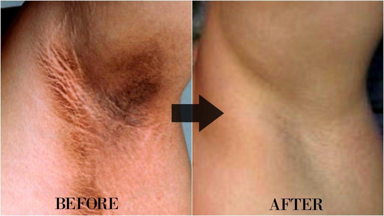 VEDANGAH VEDANGAH Anti Fungal Cream | Anti-Itching Skin Cream | Eczema | Psoriasis | Ringworm Cream 12Gm Pack Of 2