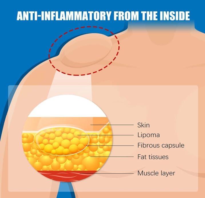 Lecherous Lipoma Removal Cream Mild Easy to Use Care Cream Wide Applaications | Mild & Comfortable | Herbal Remedies & Resins (Pack Of 3)