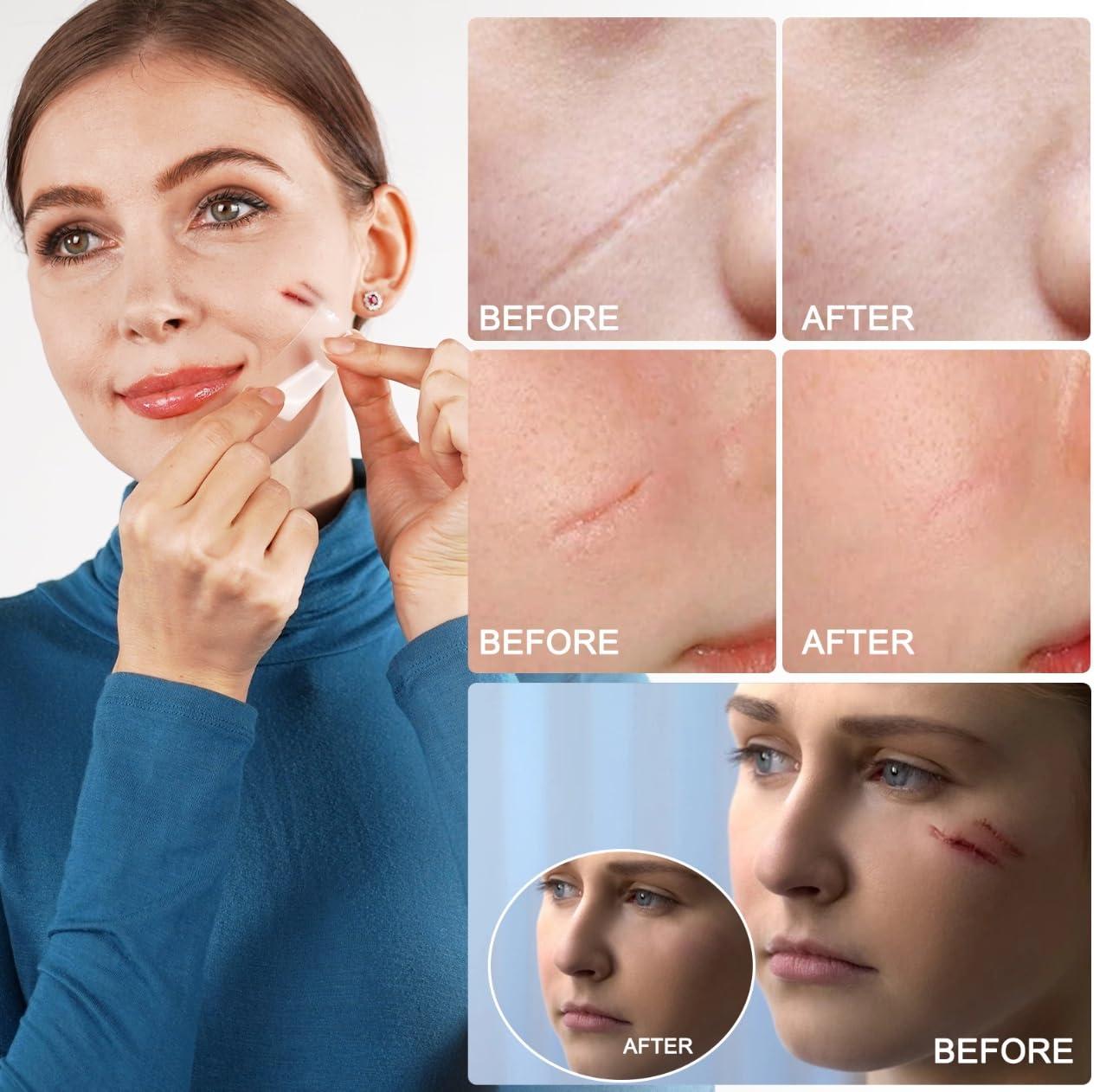 Bioline Bioline Clear Silicon Scar Sheet 4 x 150 Cm for Healing Scars Transparent tear silicone tape roll for hypertrophic scars and keloids caused by surgery, medical silicone for scar removal