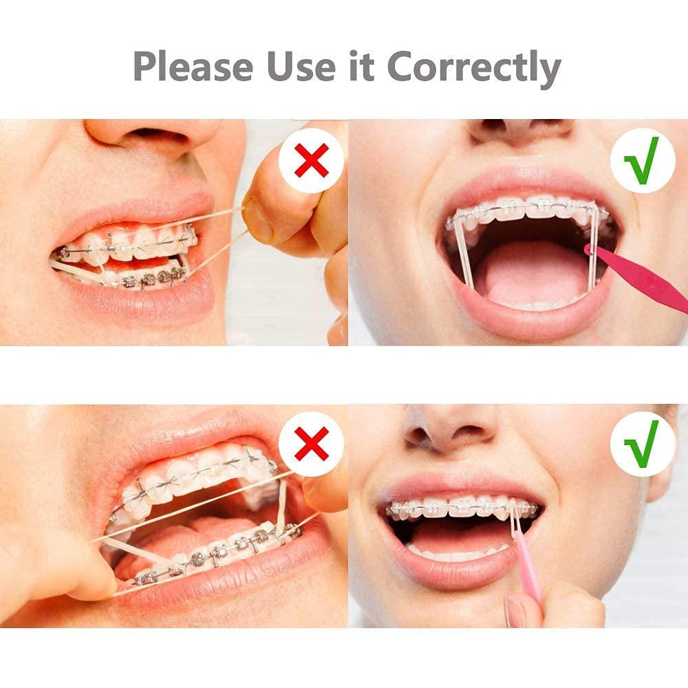 DentalSmile 100 Pcs DentalSmile Dental Teeth Gap 3/16 Neon 6.5 OZ Dental Rubber Bands XX - Heavy Dental Teeth Straightener Teeth Bands Dental Neon Bands Dentist Great for Dreadlocks, Braids, Top Knots Free Placer