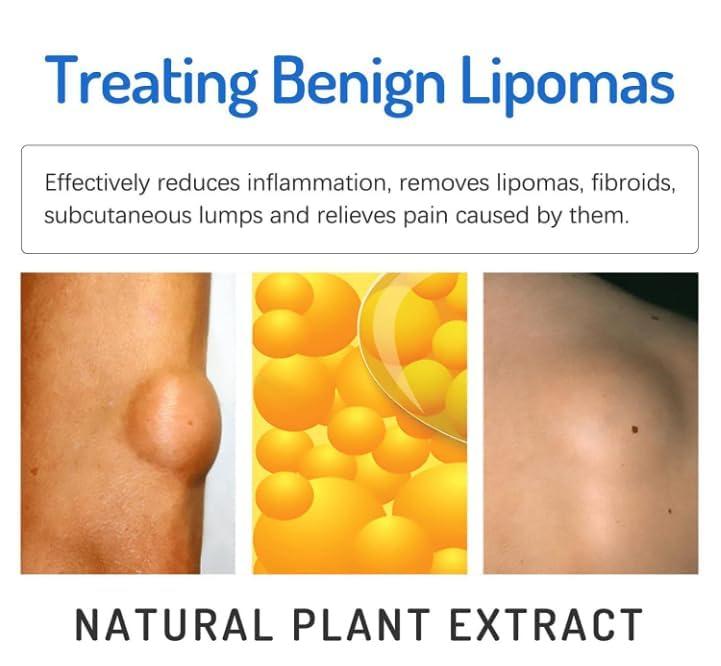 Lecherous Lipoma Removal Cream Mild Easy to Use Care Cream Wide Applaications | Mild & Comfortable | Herbal Remedies & Resins (Pack Of 3)