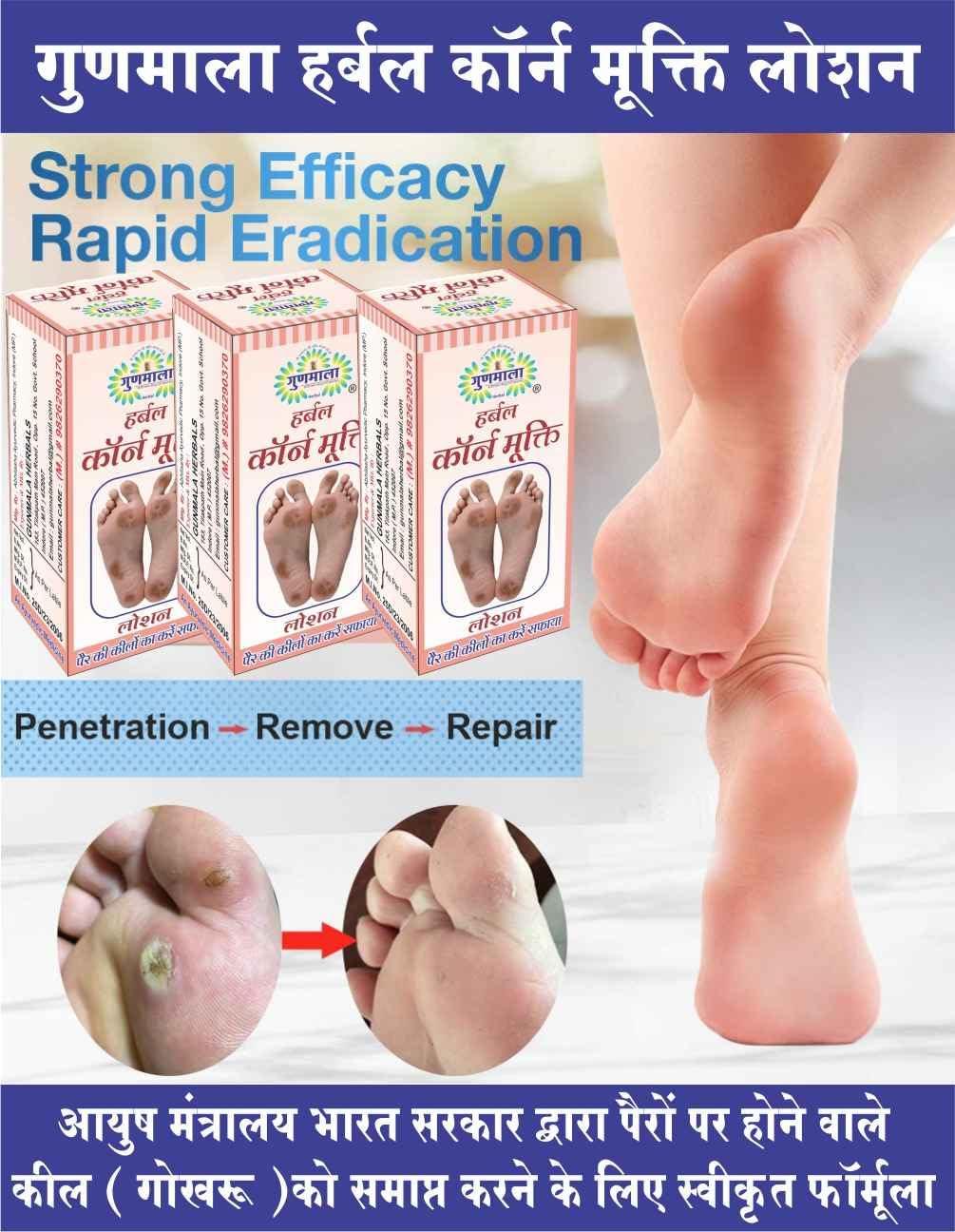 GUNMALA Herbal Foot Corn Lotion, For Remove Feet Fast And Relives From Pain & Pinch In Walking Best For Feet Infections, 5 Ml. Bottel Pack,Qty.-Pack Of 2