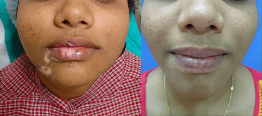 Arogya Ayurveda Kendra Herbal Remedy for Vitiligo & Leukoderma Helpful in disappearing White Patches from Skin.- Ayurveda Gift